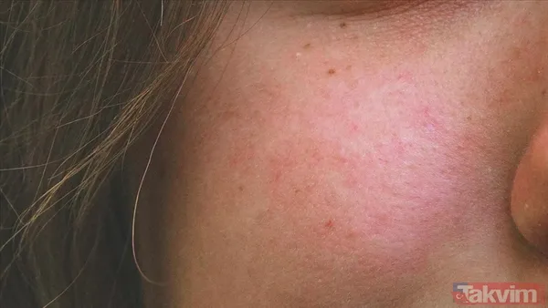 Cildiniz sonbaharda hassaslaşıyor mu? Uzmanlar kızarıklığın nedenini ve çözümünü açıkladı - 1