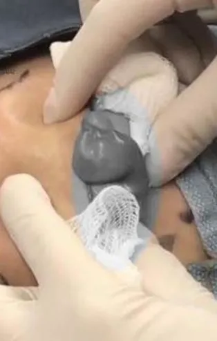 Sırtındaki şişliğin içinden çıkanlar doktoru şoke etti! Kan donduran görüntü...