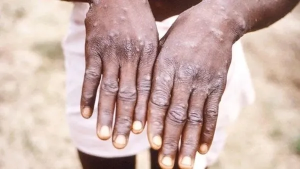 Son dakika: Sağlık Bakanı Fahrettin Koca'dan flaş maymun çiçeği virüsü açıklaması! Türkiye'de maymun çiçeği virüsü var mı?-3