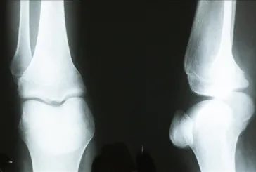 Can düşmanı kemik erimesi