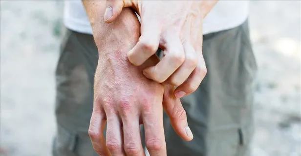 Dayanılmaz kaşıntıya neden olan egzama yaşam kalitesini düşürüyor!