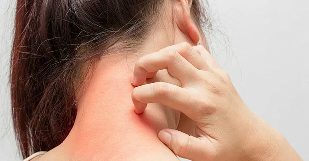 1 damlası altın gibi değerli! Kaşıntı, uyuz, egzama, kızarıklık sorununu kökünden hallediyor