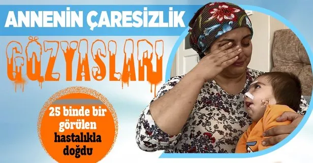 Her 25 bin bebekten birinde görülen ’Goldenhar Sendromu’ ile dünyaya geldi! Annesi dili ve çenesinden ameliyat olmasını istiyor