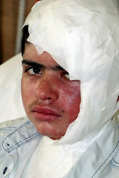 karsta-buzagi-otlatirken-kopan-yuksek-gerilim-akimina-kapilan-ebubekirin-ayak-tabanlari-patladi-1594805755711.jpg Kars'ta buzağı otlatırken kopan yüksek gerilim akımına kapılan Ebubekir'in ayak tabanları patladı-4