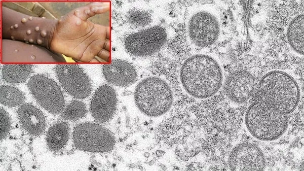 Dünya alarmda! 5 ülkede görüldü! Maymun çiçeği salgını Avrupa'yı vurdu! Maymun çiçeği hastalığı nedir, nasıl bulaşır, tedavisi var mı?-8