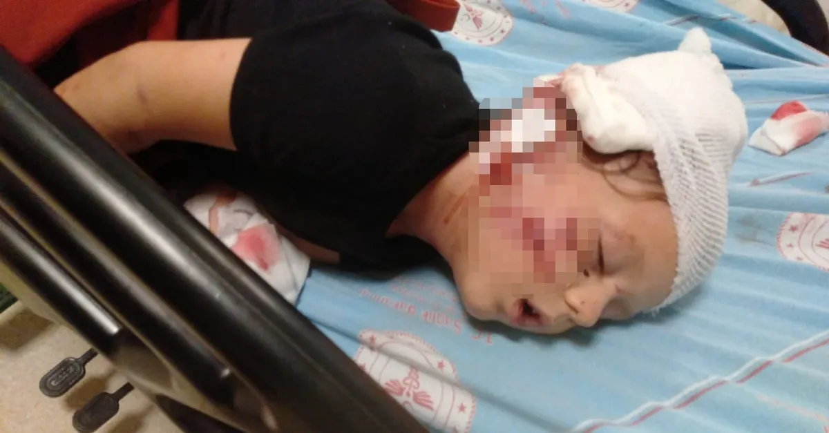 Antalya’da kulağı, kafası ve kolunu köpek ısıran küçük çocuğa 50’ye yakın dikiş atıldı