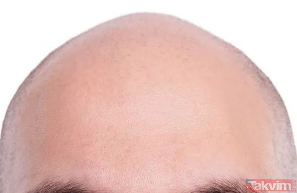 Kelliğin merhemi bulundu 40 yıl düşünsek aklımıza gelmez! Saçı olmayanlar bu haber sizin için müjde ki ne müjde - 4