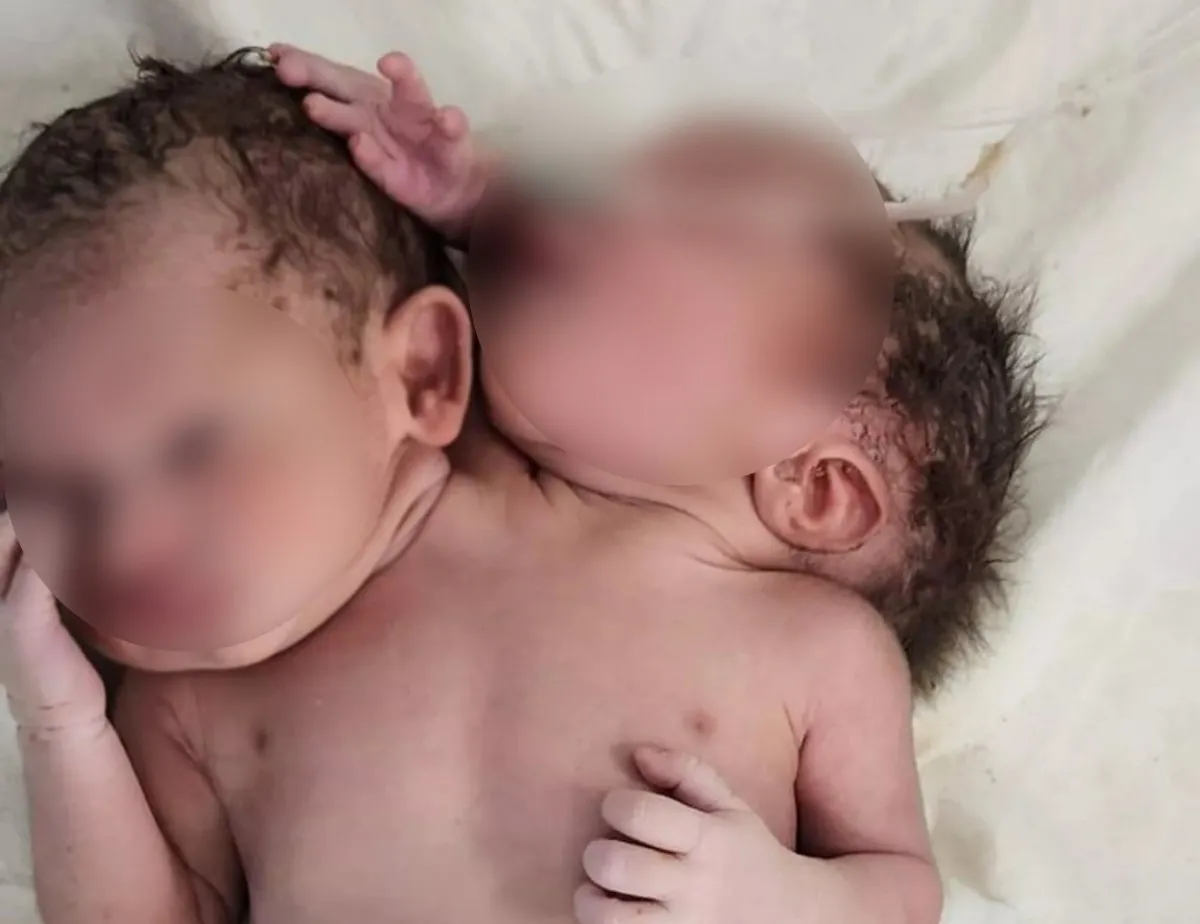 Doktorlar gözlerine inanamadı! Çift başlı bebek...