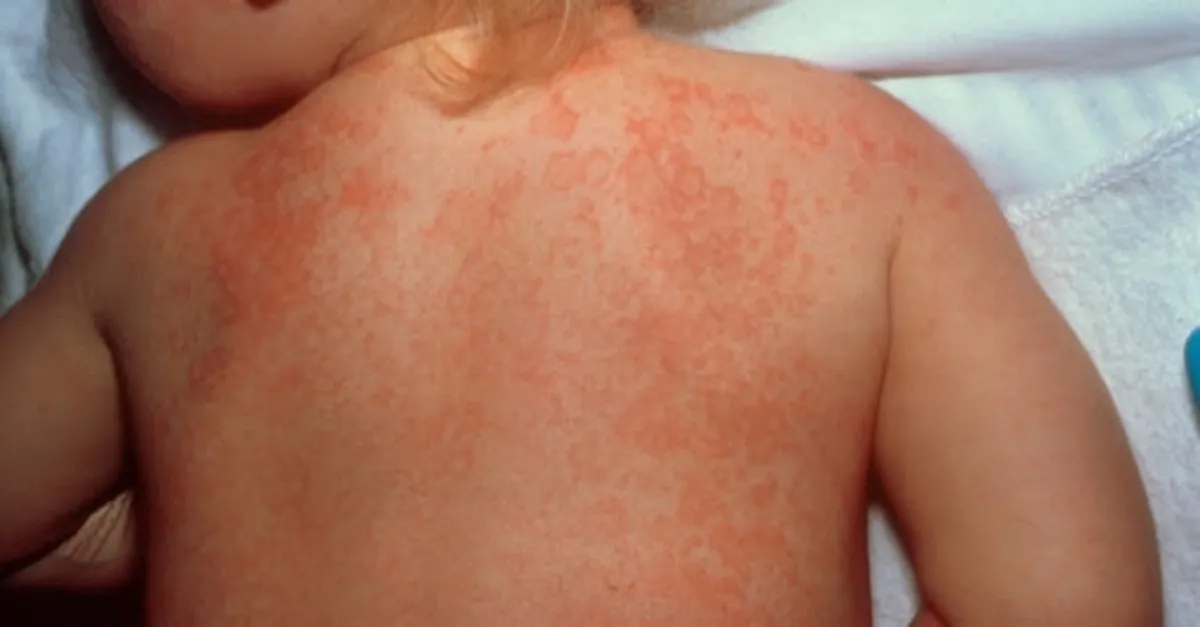 belirtileri nelerdir