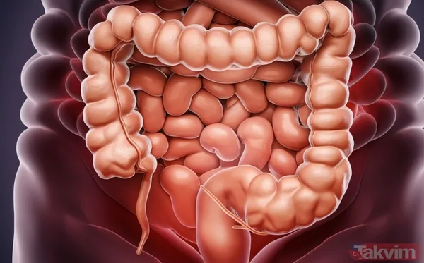 Geçmeyen Şişkinliği Normal Sanmayın! 33 Yaşındaki Genç Adamın 2 Yıl Geciken Bağırsak Kanseri Teşhisi - 1