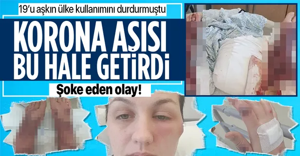 Dünya bunu konuşuyor! AstraZeneca aşısı oldu hayatı kabusa döndü! AstraZeneca aşısı genç kadını bu hale getirdi!