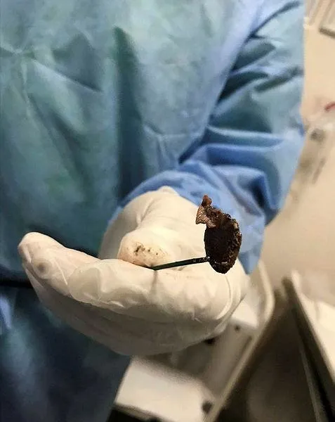oksuruk-sikayetiyle-gitti-akcigerinden-cikan-soke-etti-doktorlar-bile-saskin-1633017151970.jpeg Öksürük şikayetiyle gitti, akciğerinden çıkan şoke etti! Doktorlar bile şaşkın...-4