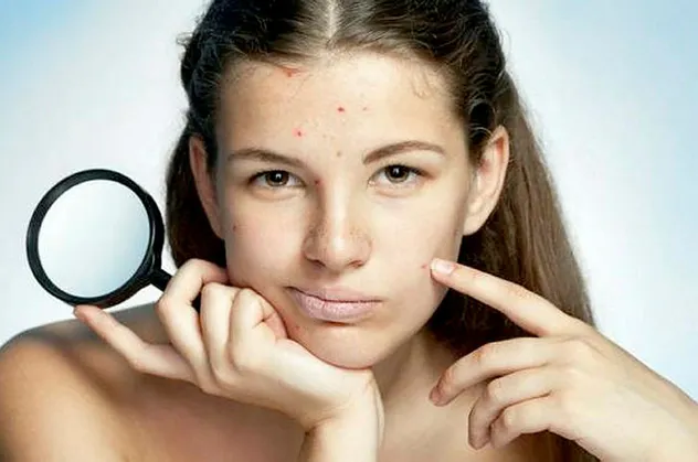 Rüyada yüzünde sivilce görmek neye işarettir, ne anlama gelir? Rüyada sivilce patlatmak hayırlı mıdır?