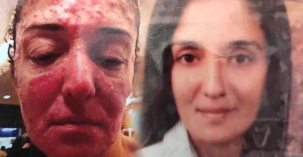 Onu patronu bu hale getirdi! Yüzüne kezzap atıp...