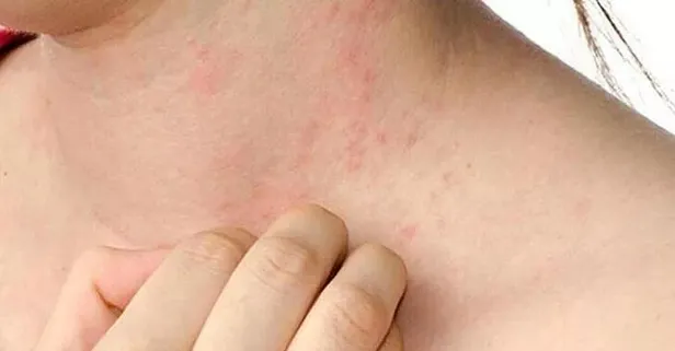 İlaç alerjisine dikkat | 19 Şubat 2022 sağlık haberleri