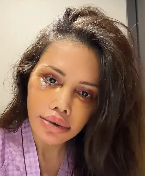 guney-korede-yuz-nakli-yaptiran-didem-ceranin-son-hali-1771060769467.jpg Güney Kore’de yüz nakli yaptıran Didem Ceran’ın son hali-4