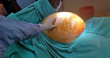 55 kilodan 91 kiloya çıktı! Yumurtalık tümörü teşhisi konulan 25 yaşındaki anneden 20 kiloluk kitle çıkarıldı
