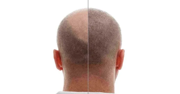 Unbekannte in der Haartransplantation…