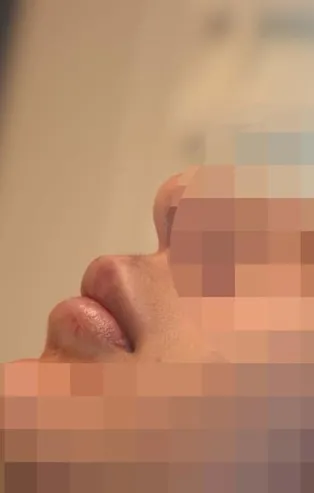 Merdiven altı işletmede yaptırdığı dolgu yüzünden dudağından oluyordu