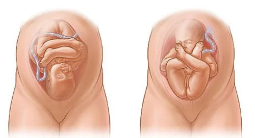 ters-dogum-nedir-dogum-kocu-evde-dogum-yaptirdi-ters-gelen-bebek-oksijensizlikten-oldu-1641992715371.jpg Ters doğum nedir? Doğum koçu evde doğum yaptırdı! Ters gelen bebek oksijensizlikten öldü-4