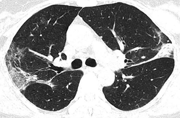 Koronavirüs ciğerleri bu hale getiriyor! Röntgen filmleri dehşete düşürdü!-5