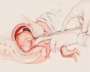 ters-dogum-nedir-dogum-kocu-evde-dogum-yaptirdi-ters-gelen-bebek-oksijensizlikten-oldu-1641993101996.jpg Ters doğum nedir? Doğum koçu evde doğum yaptırdı! Ters gelen bebek oksijensizlikten öldü-10