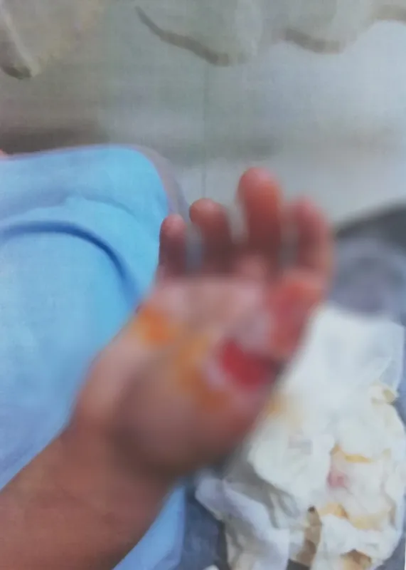 6-yasindaki-elif-kucuksorgulunun-girdigi-mr-sonrasi-eli-ve-kolunda-yaniklar-olustu-anneden-isyan-eden-sozler-1653904280492.jpg 6 yaşındaki Elif Küçüksorgulu'nun girdiği MR sonrası eli ve kolunda yanıklar oluştu! Anneden isyan eden sözler-5