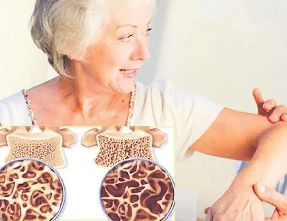 Kemik erimesi kadın düşmanı