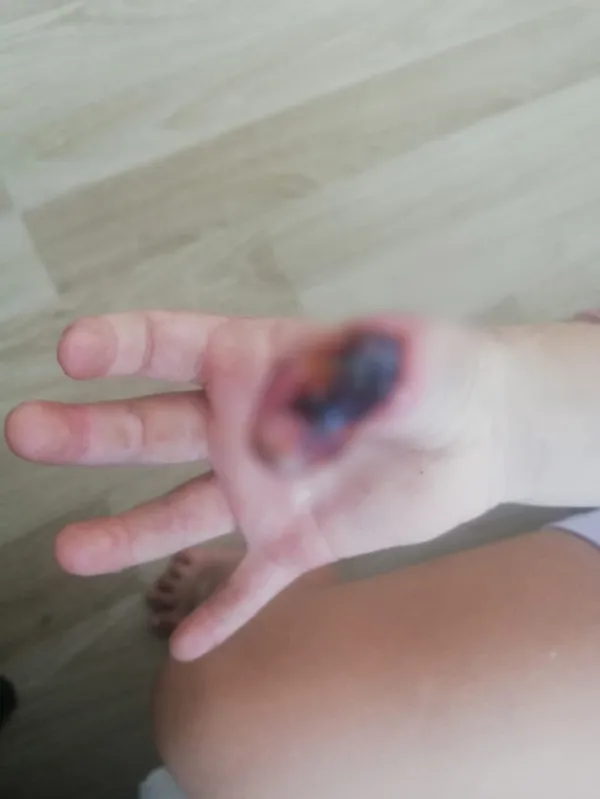 6-yasindaki-elif-kucuksorgulunun-girdigi-mr-sonrasi-eli-ve-kolunda-yaniklar-olustu-anneden-isyan-eden-sozler-1653904241123.jpg 6 yaşındaki Elif Küçüksorgulu'nun girdiği MR sonrası eli ve kolunda yanıklar oluştu! Anneden isyan eden sözler-3