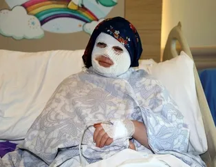 Düdüklü tencere yüzünde patladı