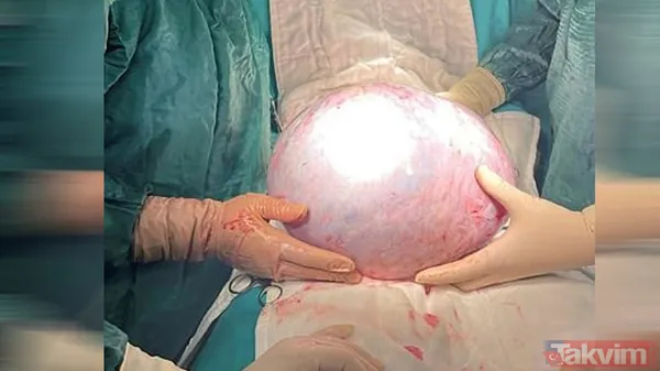 Karnındaki şişlik için gitti içinden çıkan doktorları bile şoke etti! Yer uzak değil Kayseri! 64 kilo girdi 55 kilo çıktı - 1