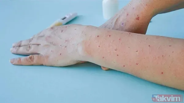 Sağlık Bakanlığı Maymun Çiçeği (MPOX) rehberi yayımladı! İşte virüsün bulaşma yolları, belirtileri ve tedavisi... - 4