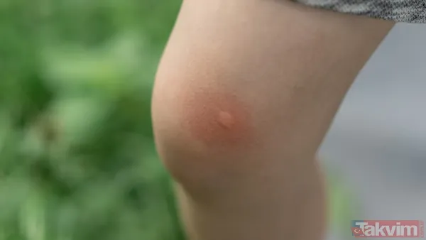 (Kaynak: Takvim Foto Arşiv, Healthshots)