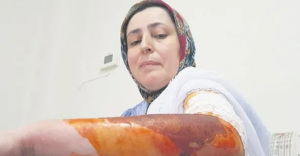 Karabük'te cani koca, eşini kaynar suyla haşladı