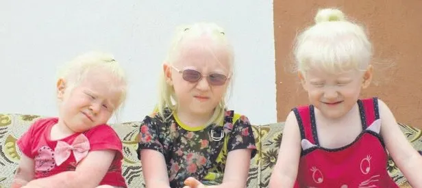 Albino kardeşler
