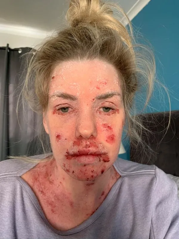 Güney Afrika’da yaşayan Samantha Saunders'ın hayatı bir krem ile değişti! Sebebini öğrenenler şoke oldu-7