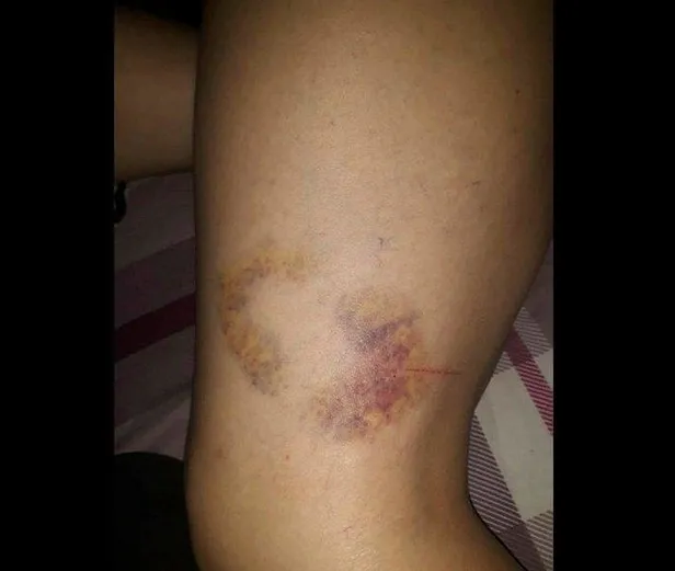 Yeni evli genç kadın 2 ayda cehennemi yaşadı: Dehşetin izlerini vücudunda taşıyor!-4