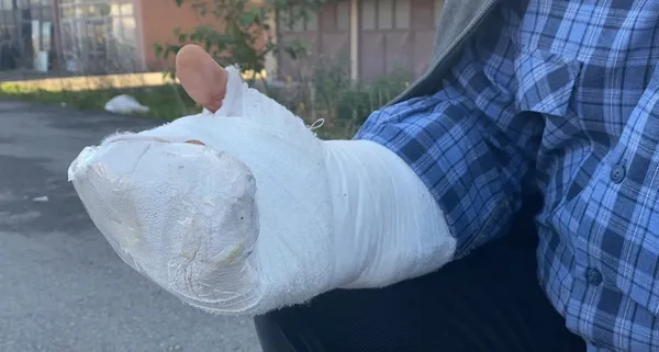 sakarya-erenlerde-59-yasindaki-bir-kisi-yola-konulan-mantar-taslara-6-kez-takilarak-dustu-en-sonunda-kolunu-kesti-1607600152706.jpg Sakarya Erenler'de 59 yaşındaki bir kişi yola konulan mantar taşlara 6 kez takılarak düştü en sonunda kolunu kesti-9