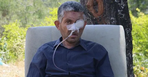 Dişini çektirdikten sonra gözünü kaybettiği ileri sürülen Mustafa Bulat’ın gözünü kanserden baybettiği ortaya çıktı
