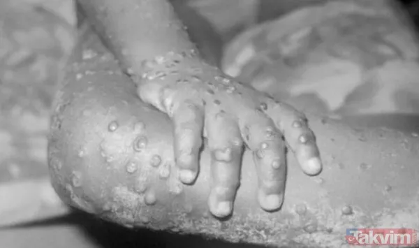 Küresel maymun çiçeği vakalarında artış! DSÖ son verileri duyurdu: Maymun çiçeği nasıl yayılıyor? Hastalığın belirtileri neler? - 16