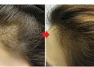 2 ayda 6 cm uzatıyor! Genetik kelliğe biberiye yağı çözümü! Bu yöntemle tutam tutam saç fışkıracak