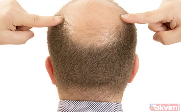 Kelliğin merhemi bulundu 40 yıl düşünsek aklımıza gelmez! Saçı olmayanlar bu haber sizin için müjde ki ne müjde - 6