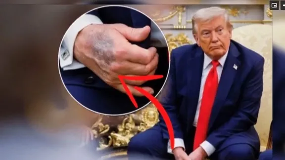 ABD’de Trump spekülasyonları: Morluk ve şişlik iddiaları gündemde