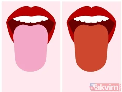 🌀 Şekil Ve Kenarlar Şiş Ve Kenarları Tırtıklı Dil: Besin Emiliminde Bozukluk Olabilir. Aşırı İnce Dil: Susuzluk Belirtisi Olabilir. Haritalı Dil (Geographic...