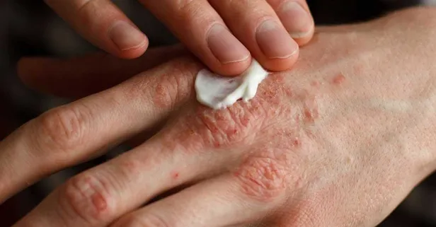Uzmanı son dönemde artan egzama hastalığına karşı uyardı: İşte bilinmesi gerekenler...