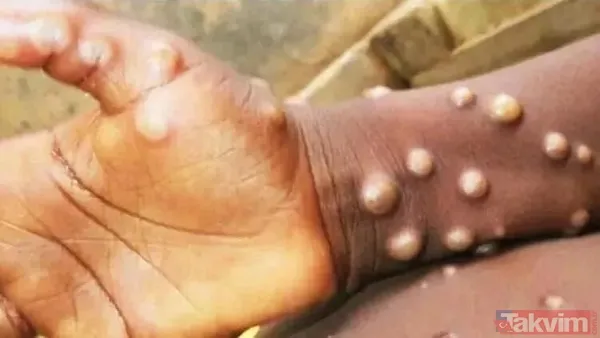 Küresel maymun çiçeği vakalarında artış! DSÖ son verileri duyurdu: Maymun çiçeği nasıl yayılıyor? Hastalığın belirtileri neler? - 13