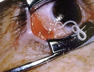 Gözdeki parazite dikkat