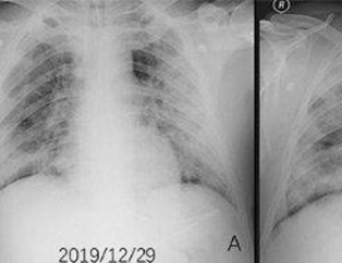 Koronavirüsü nasıl geçireceğimizi öğrenmek artık mümkün!