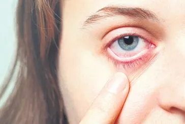 Gözde et büyümesine Pterjium yol açan 4 sinsi neden: Uzmanından hayati uyarılar