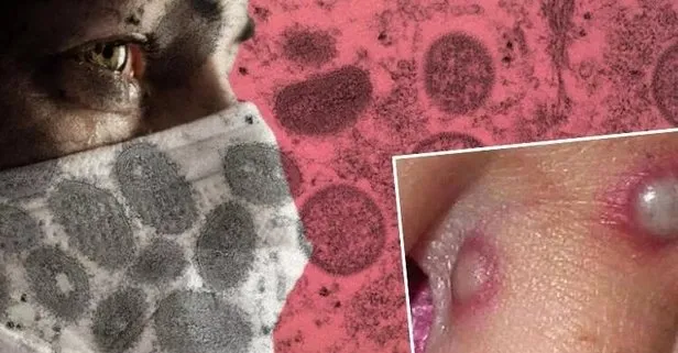 Almanya’dan maymun çiçeğine karşı 40 bin dozluk aşı